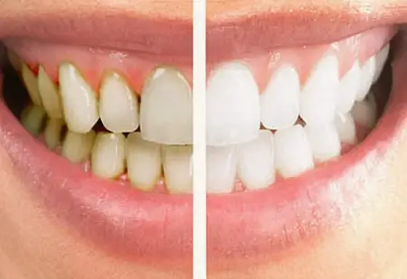 Before and after teeth whitening comparison showing stained teeth on the left and bright white teeth on the right.