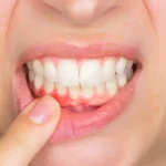 A close-up of inflamed gums showing redness and irritation, a common symptom of gingivitis