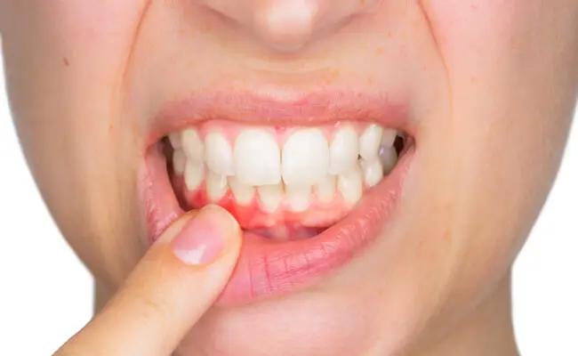 A close-up of inflamed gums showing redness and irritation, a common symptom of gingivitis