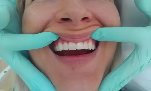 Close-up of a patient's smile with metal-ceramic prosthetic teeth installed, handled by a professional dentist at Dent VIP in Chișinău