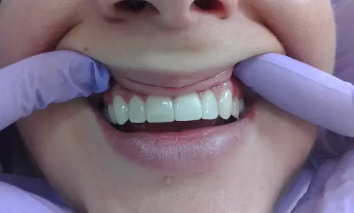 Close-up of a patient's smile showing perfectly aligned zirconium veneers, handled by a professional dentist at Dent VIP in Chișinău