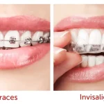 A side-by-side comparison showing traditional braces on the left and Invisalign clear aligners on the right for teeth straightening