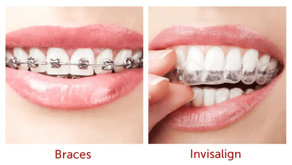 A side-by-side comparison showing traditional braces on the left and Invisalign clear aligners on the right for teeth straightening