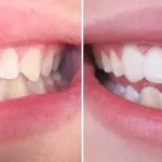 A side-by-side comparison of a smile before and after LUMINEERS application at Dent VIP Clinic in Chișinău, Moldova