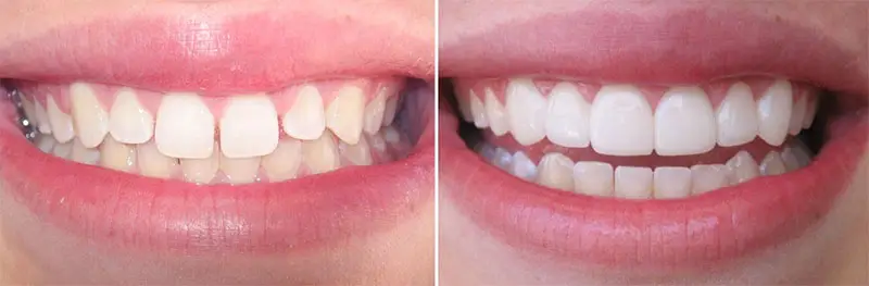 A side-by-side comparison of a smile before and after LUMINEERS application at Dent VIP Clinic in Chișinău, Moldova