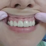 A close-up of a smile enhanced with LUMINEERS, showcasing natural-looking dental veneers at Dent VIP Clinic in Chișinău, Moldova