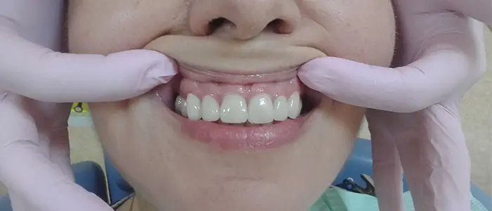 A close-up of a smile enhanced with LUMINEERS, showcasing natural-looking dental veneers at Dent VIP Clinic in Chișinău, Moldova