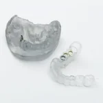 Ghid chirurgical transparent și model dentar utilizate pentru plasarea precisă a implanturilor dentare