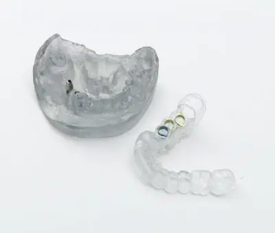 Ghid chirurgical transparent și model dentar utilizate pentru plasarea precisă a implanturilor dentare