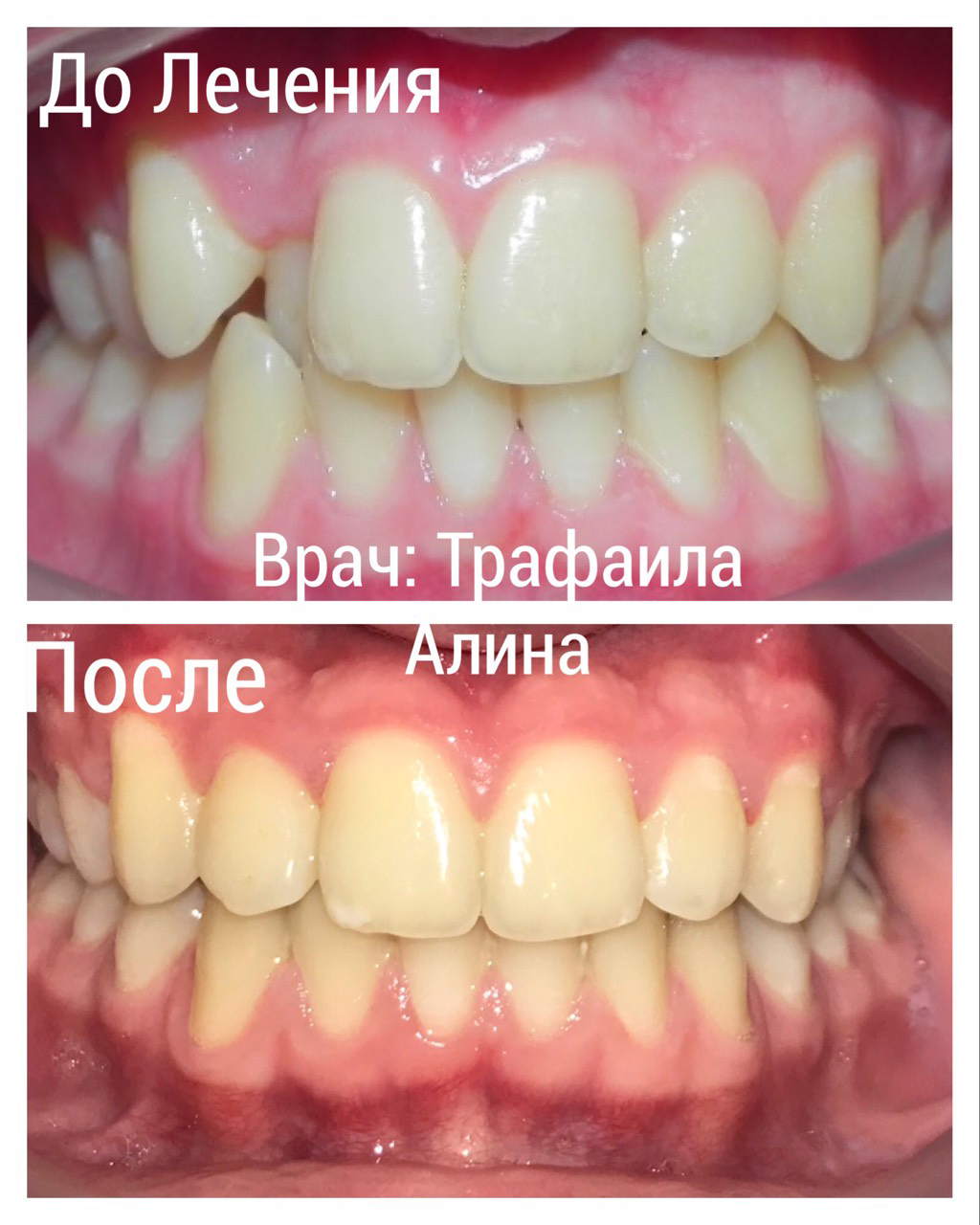 Результаты исправления прикуса: До лечения и после ортодонтического вмешательства