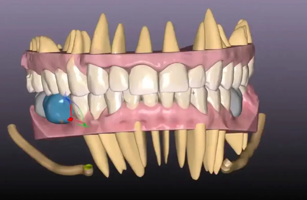 3D model of teeth for planning orthodontic treatment with braces