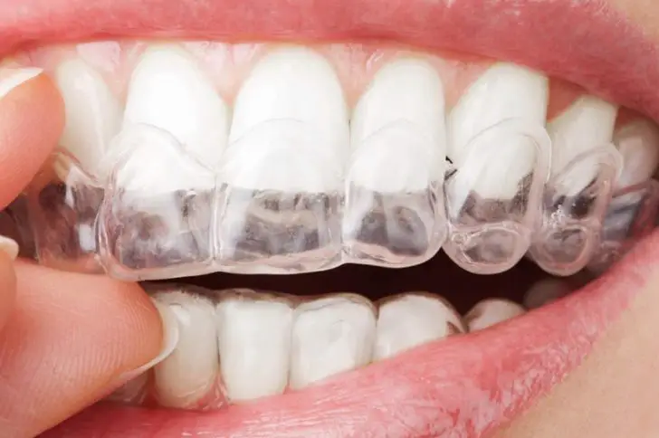 Removable clear aligners for teeth straightening