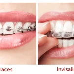 Сравнение традиционных брекетов и прозрачных капп Invisalign для выравнивания зубов