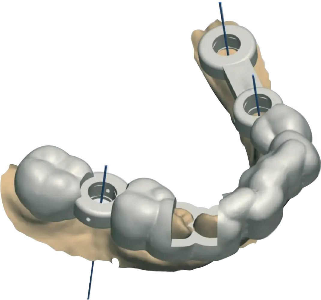 Digital model of a surgical guide for dental implantation