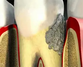 Tartar buildup and gum inflammation: a diagram of periodontitis development