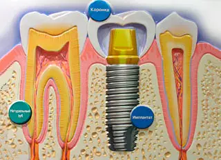 Implant placement Chisinau Moldova