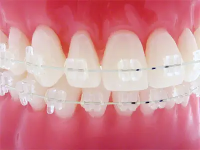 Ceramic braces on teeth for malocclusion correction