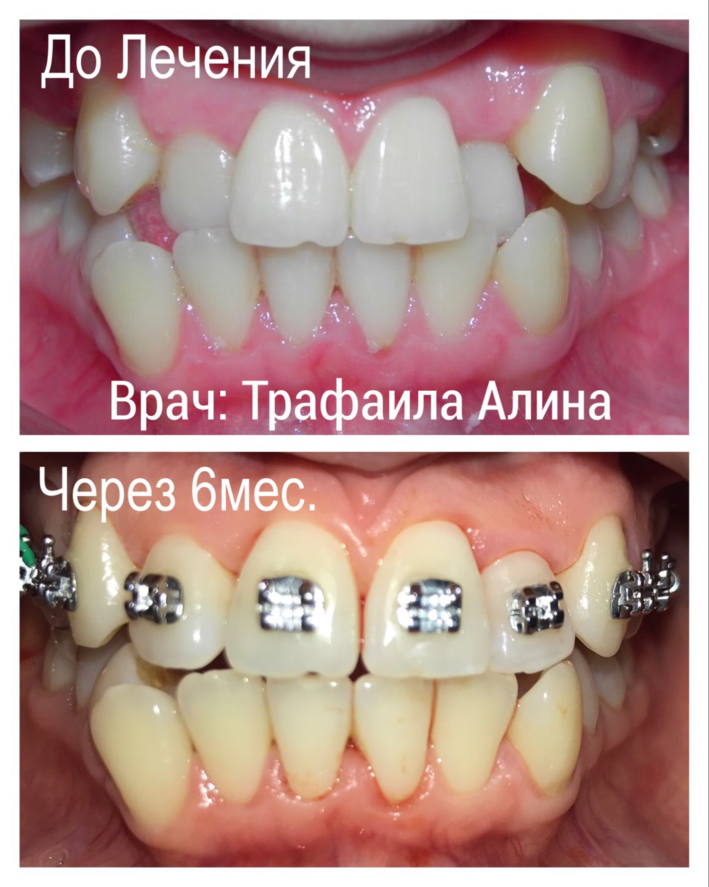Исправление прикуса с использованием брекетов: результаты через 6 месяцев лечения