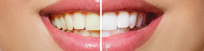 Comparison of teeth before and after the whitening procedure