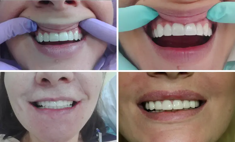 Patient's smile after installing zirconia crowns